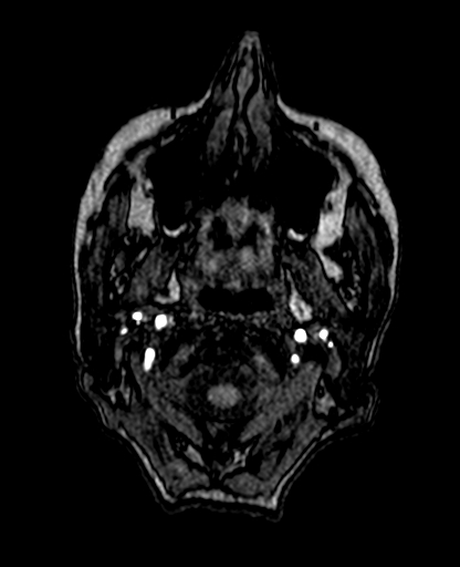 File:Berry aneurysm of the terminal internal carotid artery (Radiopaedia 88286-104918 Axial TOF 16).jpg