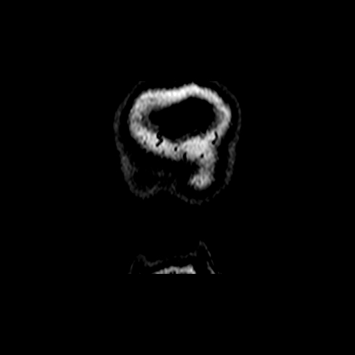 Berry aneurysm of the terminal internal carotid artery (Radiopaedia 88286-104918 Coronal TOF 132).jpg