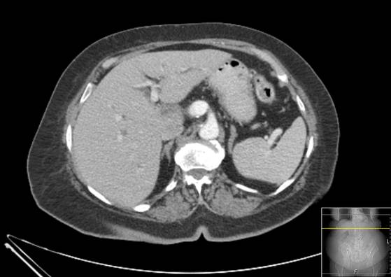 Bicameral celiacomesenteric aneurysm (Radiopaedia 55766-62327 A 14).jpg