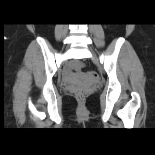 File:Bicornuate uterus- on MRI (Radiopaedia 49206-54296 Coronal non-contrast 14).jpg