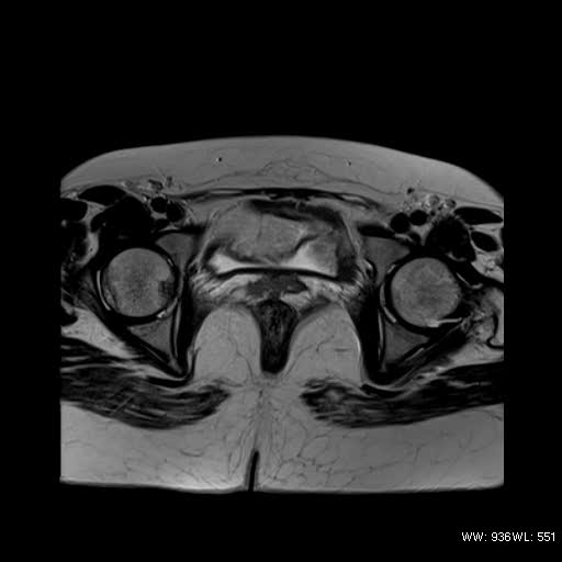 File:Bicornuate uterus- on MRI (Radiopaedia 49206-54297 Axial T2 13).jpg