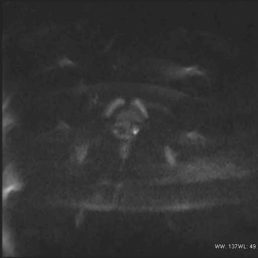 File:Bicornuate uterus (MRI) (Radiopaedia 49206-54297 Axial 109).jpg