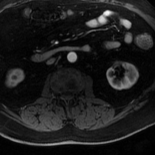 Bifid pancreatic tail (Radiopaedia 16503-16185 Axial T1 C+ fat sat 58).jpg