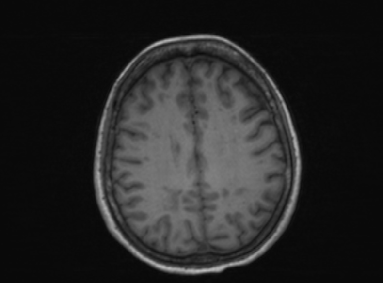 File:Bilateral PCA territory infarction - different ages (Radiopaedia 46200-51784 Axial T1 192).jpg