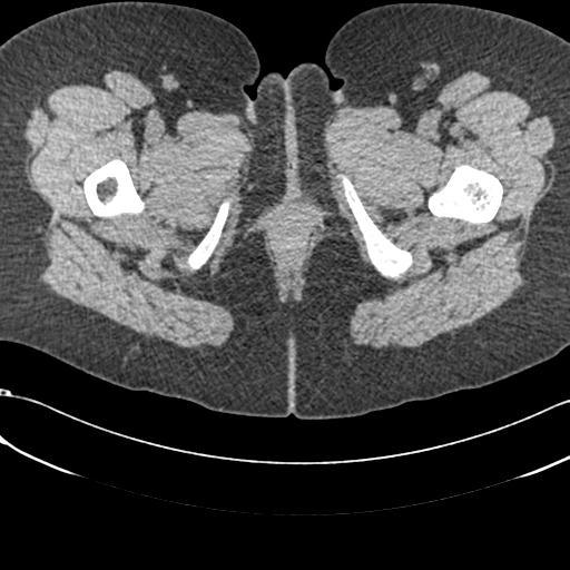 File:Bilateral acetabular protrusion with pincer type femoro-acetabular impingement (Radiopaedia 30134-30733 AXIAL SOFT THIN 110).jpg