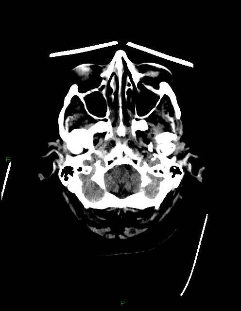 Bilateral acute middle cerebral artery territory infarcts (Radiopaedia 77319-89401 Axial non-contrast 9).jpg