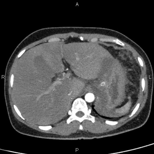 Bilateral adrenal gland hyperenhancement in pancreatitis (Radiopaedia 86642-102753 B 21).jpg
