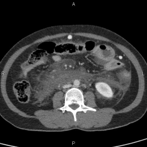 Bilateral adrenal gland hyperenhancement in pancreatitis (Radiopaedia 86642-102753 E 63).jpg