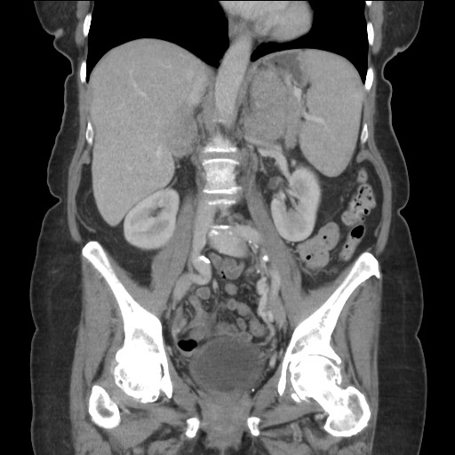Bilateral adrenal granulocytic sarcomas (chloromas) (Radiopaedia 78375-91007 B 53).jpg