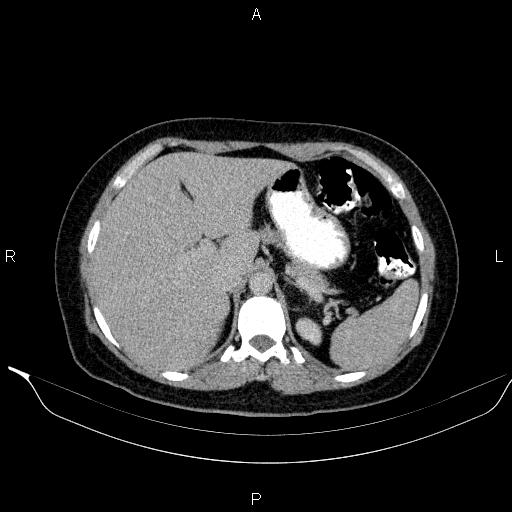Bilateral adrenal myelolipoma (Radiopaedia 63058-71535 Axial C+ delayed 17).jpg