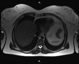 File:Bilateral adrenal myelolipoma (Radiopaedia 63058-71537 Axial T2 5).jpg