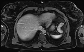 File:Bilateral adrenal myelolipoma (Radiopaedia 63058-71537 H 14).jpg