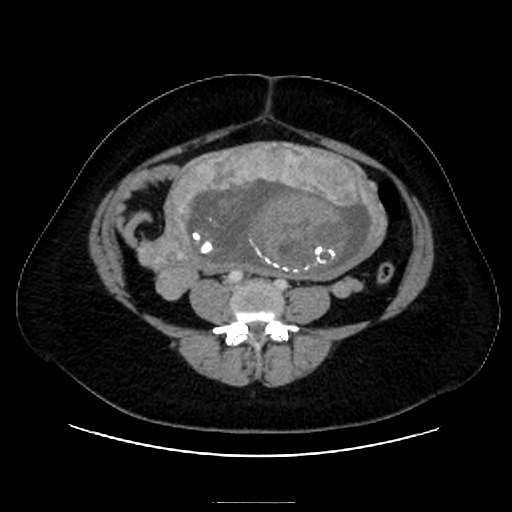 Bilateral adrenal thrombosis (Radiopaedia 58182-65256 A 49).jpg