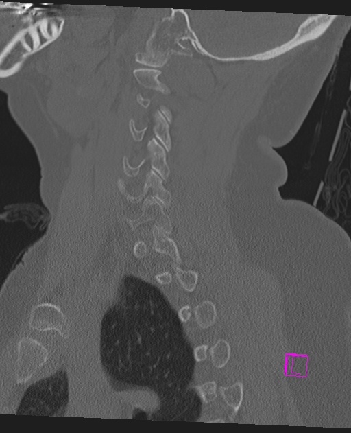 Bilateral atlanto-occipital assimilation (Radiopaedia 28350-28603 Sagittal bone window 55).jpg