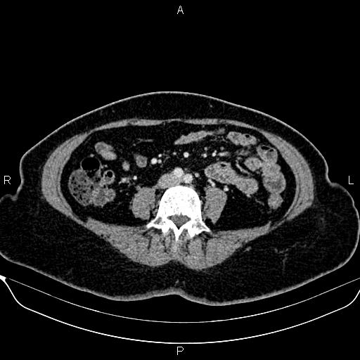 Bilateral benign adrenal adenomas (Radiopaedia 86912-103124 B 66).jpg