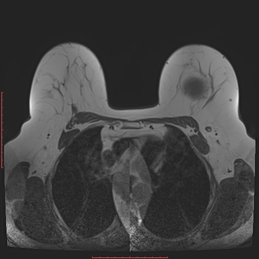 File:Bilateral breast implant rupture (Radiopaedia 24761-25027 T1 13).jpg