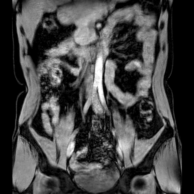 Bilateral conjoined nerve roots at different levels (Radiopaedia 73312-84063 Coronal WE 2).jpg