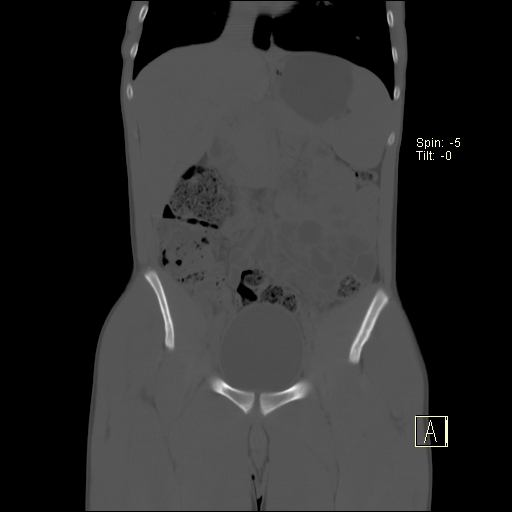 File:Bilateral cortical nephrocalcinosis (Radiopaedia 73165-83886 Coronal bone window 8).jpg