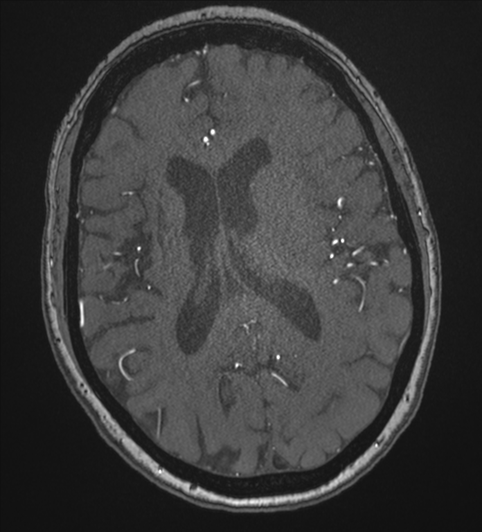 Bilateral fetal posterior communicating arteries (Radiopaedia 41286-44102 Axial MRA 130).png