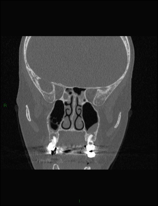 Bilateral frontal mucoceles (Radiopaedia 82352-96454 Coronal 174).jpg