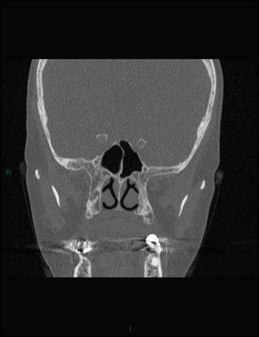 Bilateral frontal mucoceles (Radiopaedia 82352-96454 Coronal 207).jpg