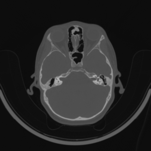 Bilateral otosclerosis (Radiopaedia 57237-64157 C 52).jpg