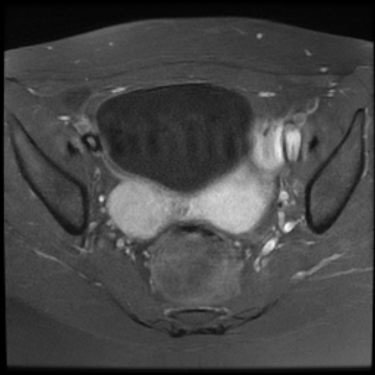 File:Bilateral ovarian fibrothecomas - adolescent (Radiopaedia 86604-102707 Axial T1 C+ fat sat 16).jpg