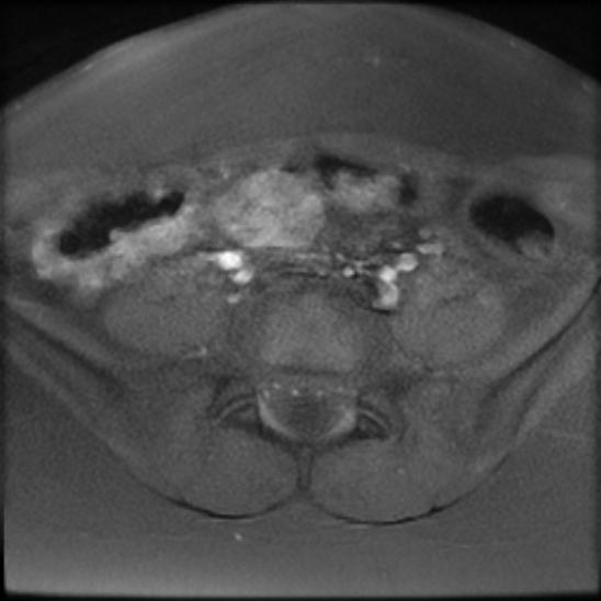 File:Bilateral ovarian fibrothecomas - adolescent (Radiopaedia 86604-102707 Axial T1 fat sat 4).jpg