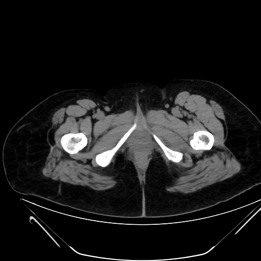 Bilateral ovarian mature cystic teratomas (Radiopaedia 79373-92457 Axial non-contrast 103).jpg