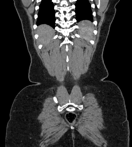Bilateral ovarian mature cystic teratomas (Radiopaedia 79373-92457 B 100).jpg