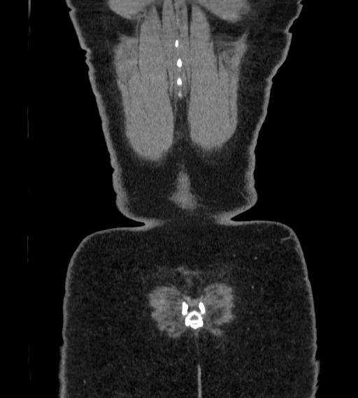 Bilateral ovarian mature cystic teratomas (Radiopaedia 79373-92457 B 109).jpg
