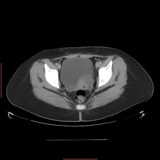 File:Bilateral ovarian serous cystadenocarcinoma with right ovarian torsion (Radiopaedia 32640-33611 A 39).jpg