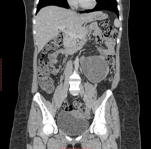 File:Bilateral ovarian serous cystadenocarcinoma with right ovarian torsion (Radiopaedia 32640-33611 B 18).jpg