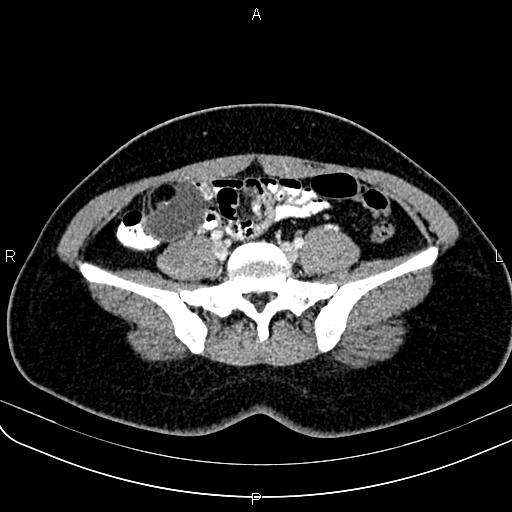 File:Bilateral ovarian teratoma (Radiopaedia 83131-97503 Axial With contrast 15).jpg