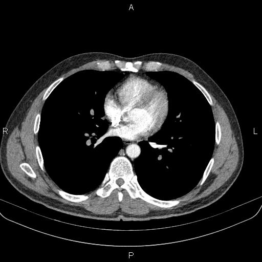 Bilateral pulmonary AVM (Radiopaedia 83134-97505 A 43).jpg