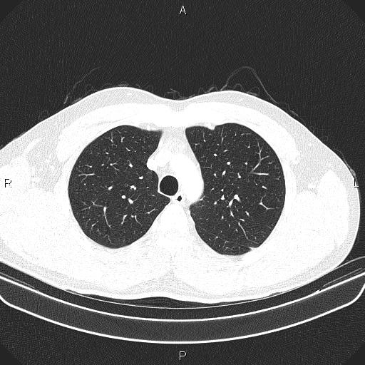File:Bilateral pulmonary AVM (Radiopaedia 83134-97505 Axial lung window 20).jpg