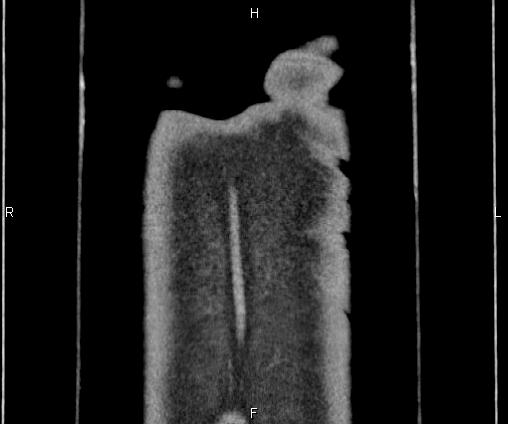 Bilateral pulmonary AVM (Radiopaedia 83134-97505 C 80).jpg