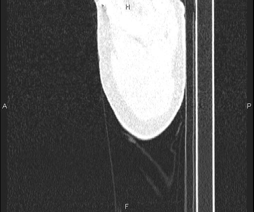 File:Bilateral pulmonary AVM (Radiopaedia 83134-97505 Sagittal lung window 5).jpg