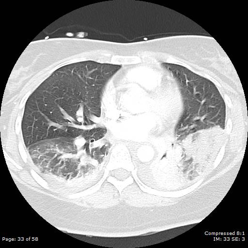 Bilateral pulmonary emboli with Hampton hump sign (Radiopaedia 54070-60246 Axial lung window 33).jpg