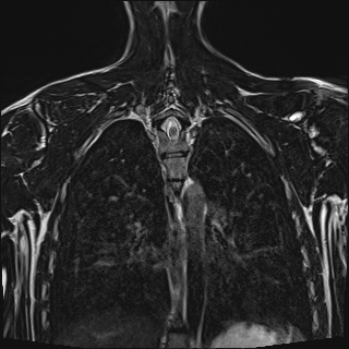 Bilateral spinoglenoid notch ganglion cysts (Radiopaedia 29577-30082 Coronal T2 91).jpg