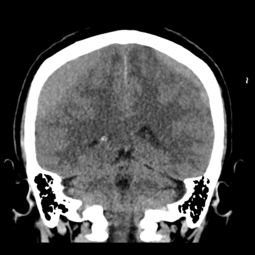 File:Bilateral subacute subdural hematoma (Radiopaedia 69240-79018 Coronal non-contrast 38).jpg