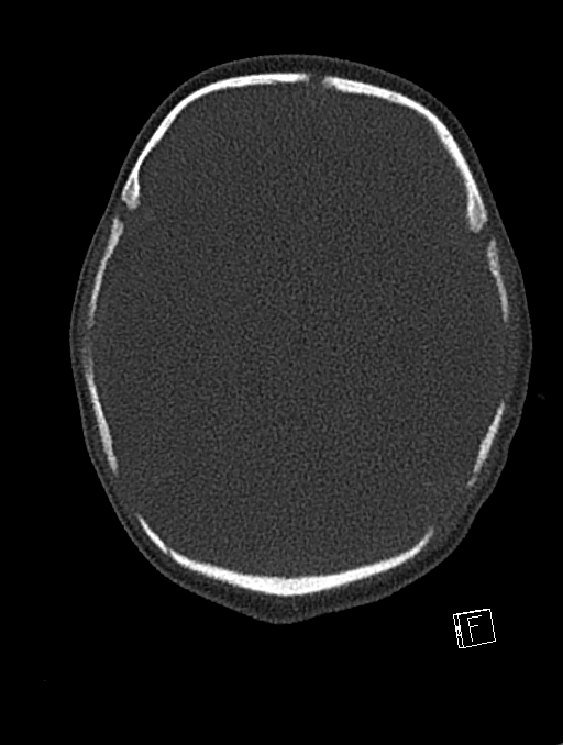Bilateral subdural hemorrhage and parietal skull fracture (Radiopaedia 26058-26192 Axial bone window 84).png