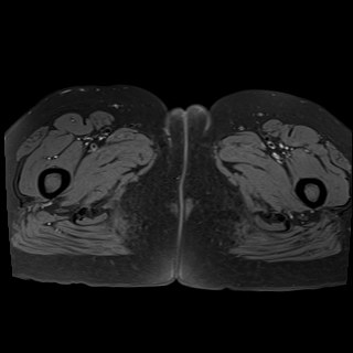 Bilateral tubo-ovarian abscesses (Radiopaedia 58635-65829 Axial T1 fat sat 53).jpg
