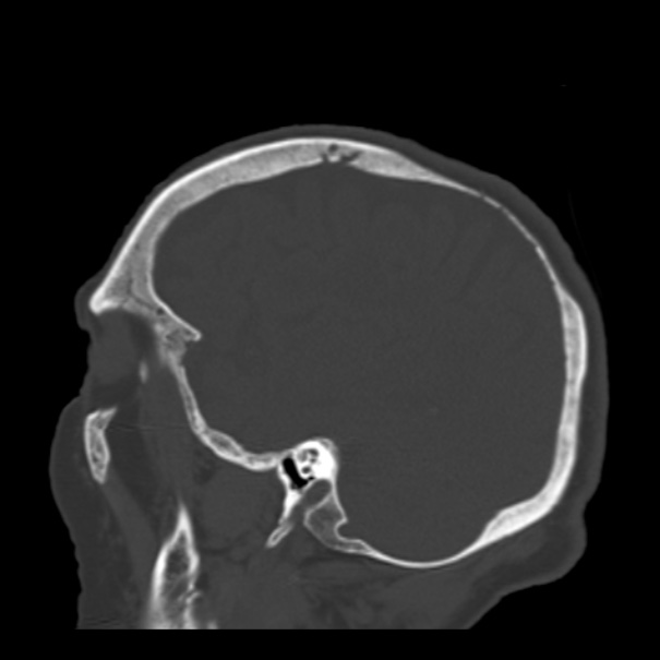 Biparietal osteodystrophy (Radiopaedia 46109-50463 Sagittal bone window 29).jpg