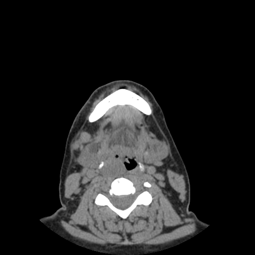 Bisphosphonate-related osteonecrosis of the jaw (Radiopaedia 71324-81642 non-contrast 21).jpg