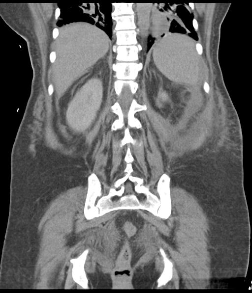 Bladder rupture post renal biopsy (Radiopaedia 30863-31572 Coronal non-contrast 45).jpg