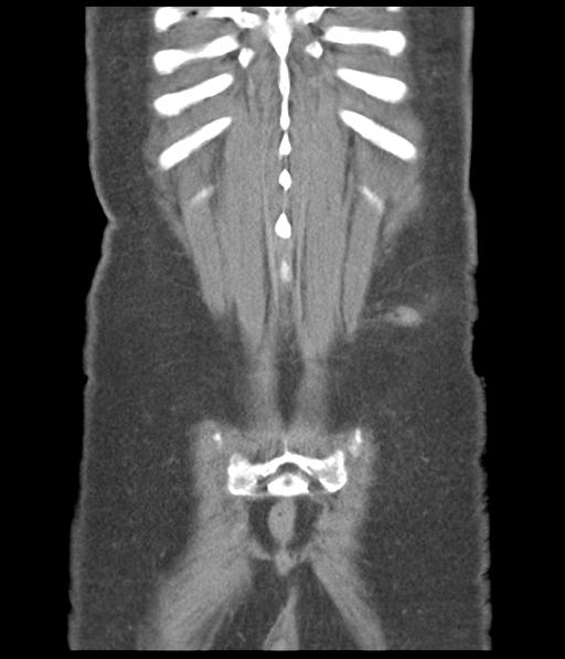 File:Bladder rupture post renal biopsy (Radiopaedia 30863-31572 Coronal non-contrast 51).jpg