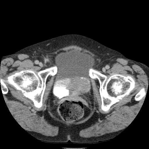 Bladder tumor detected on trauma CT (Radiopaedia 51809-57609 C 135).jpg