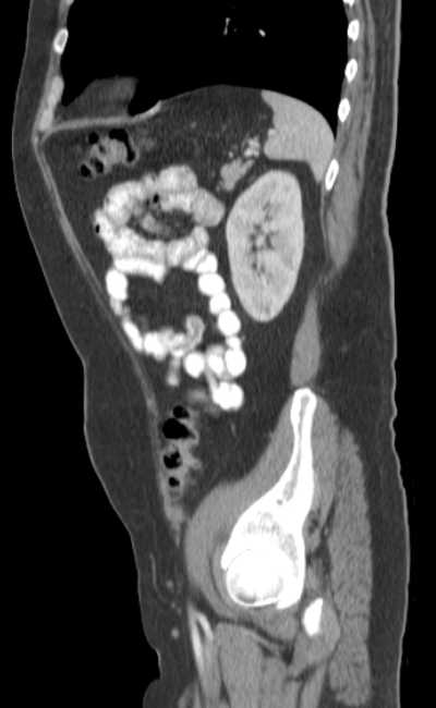 Bleeding duodenal ulcer and adenomyomatosis of gallbladder (Radiopaedia 61834-69861 C 78).jpg