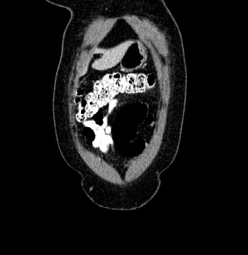 Blind-ending branch of a bifid ureter (Radiopaedia 61159-69048 C 6).jpg